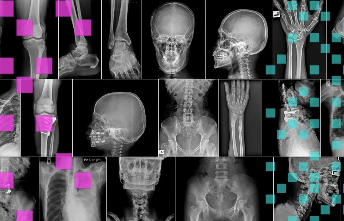 ބިންދައިގެންދާ ކަށިގަނޑު ދެނެގަތުން އަވަސްކުރުމަށް އިނގިރޭސި ވިލާތުގެ ހޮސްޕިޓަލްތަކުން އޭއައި ނިޒާމެއް ބޭނުންކުރަން ފަށައިފި